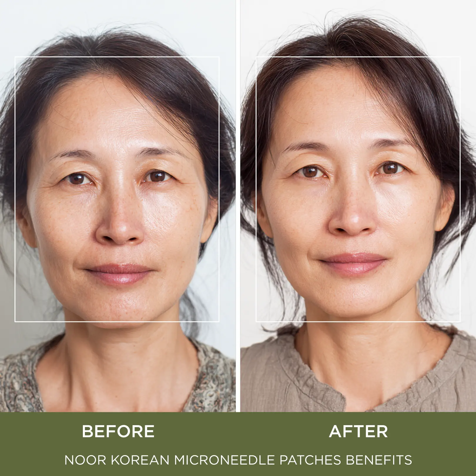 Advanced K-Beauty Microneedle Combo Mask - Image 6