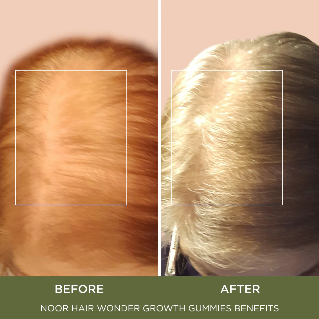 Wonder Growth Gummies - Image 4